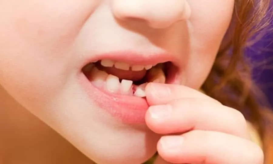 Chiêm bao thấy rụng răng hàm dưới