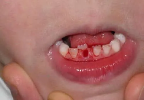 Mộng thấy rụng răng chảy máu