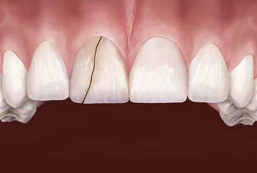 Mơ thấy răng giả bị bể