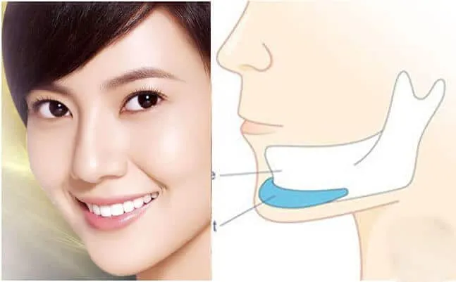 Chiêm bao thấy phẩu thuật độn cằm