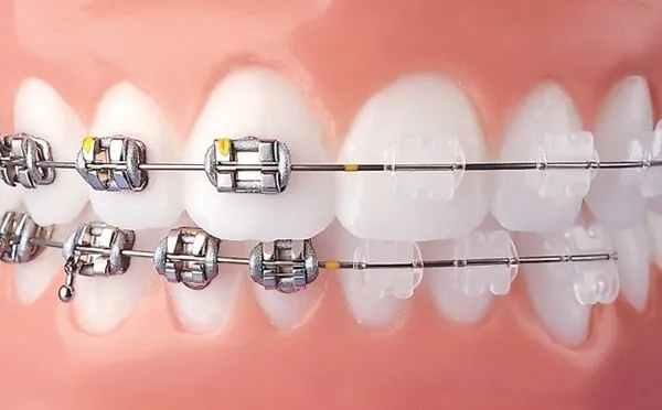 Mơ thấy niềng răng cả hai hàm