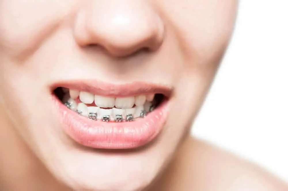 Nằm mơ thấy niềng răng hàm dưới