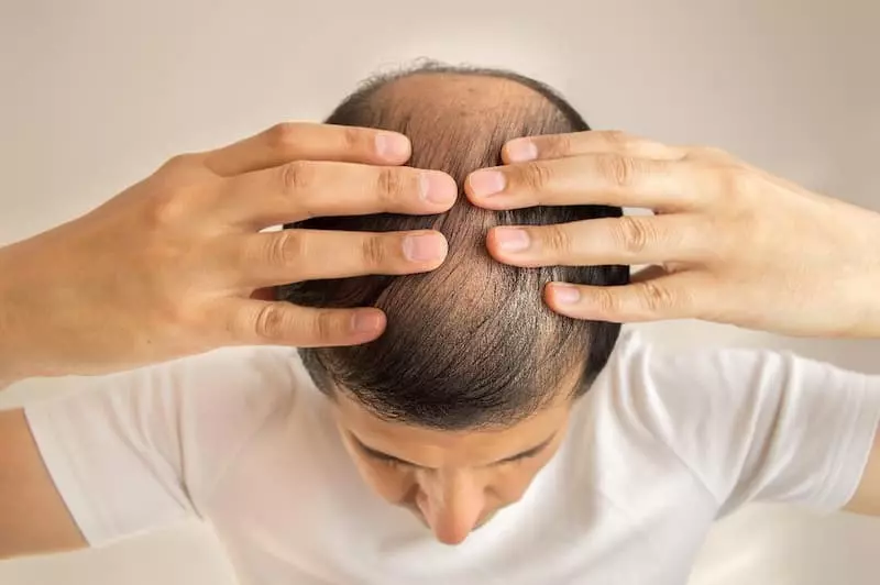 nằm mơ thấy rụng tóc đánh số gì
